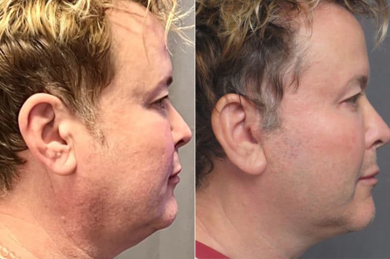 patient-1216-facelift-before-after-1-768x511