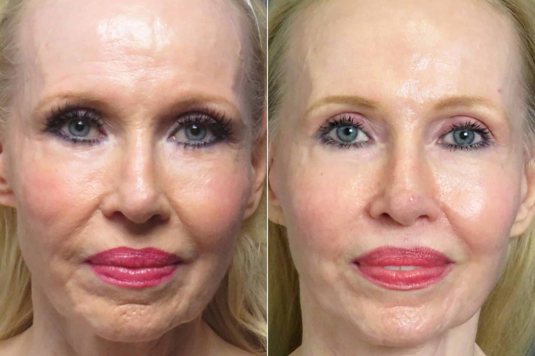 patient-1247-facelift-before-after-3-2048x1363