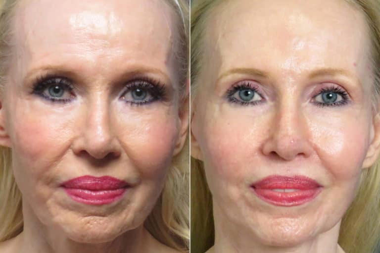 patient-1247-facelift-before-after-3-768x511