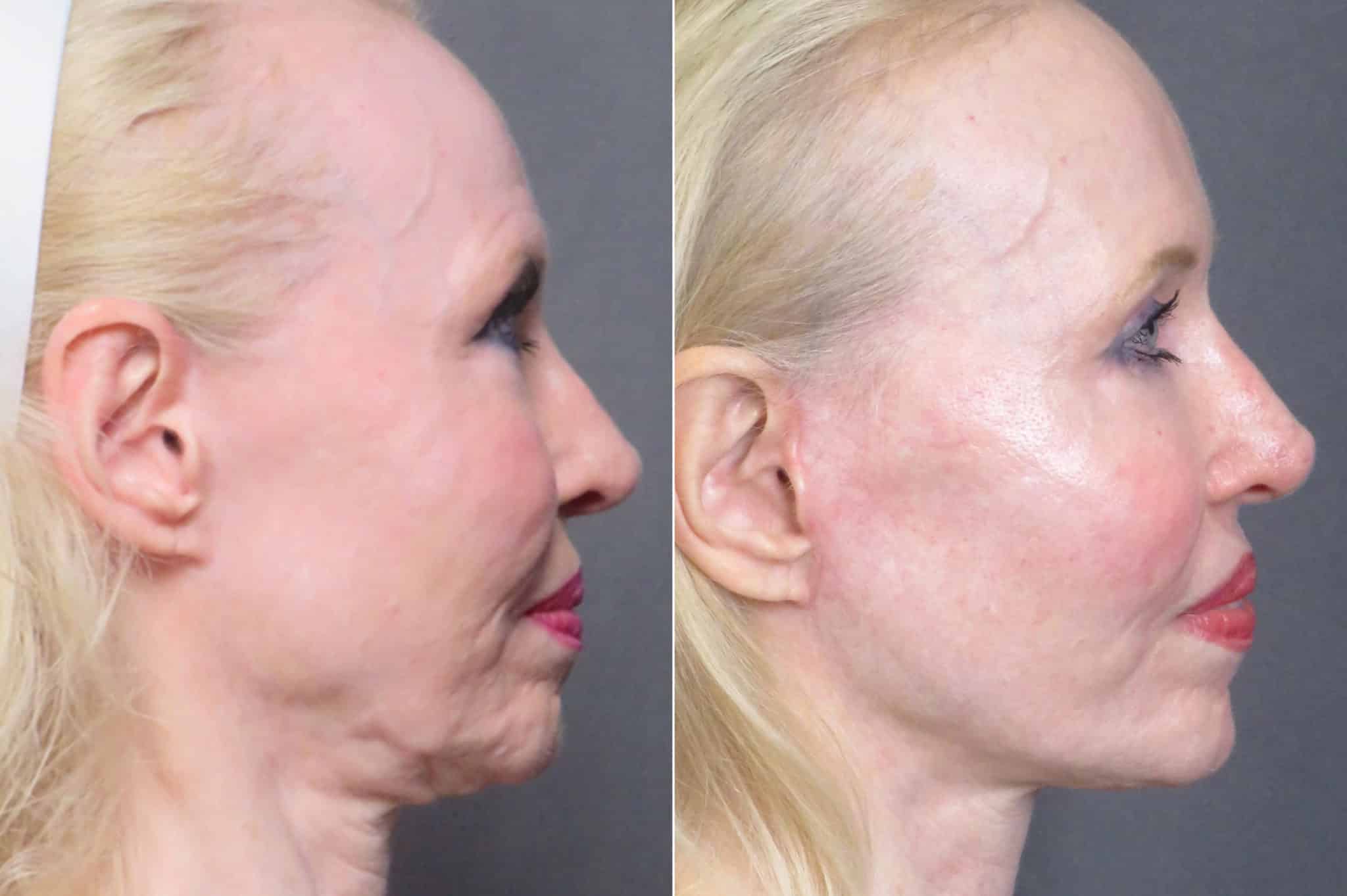 patient-1247-facelift-before-after-4-2048x1363