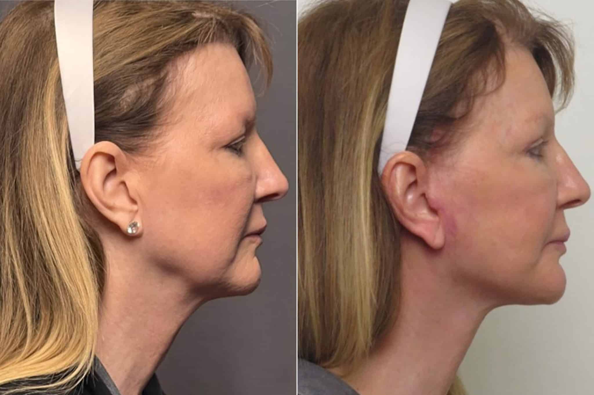 patient-1256-facelift-before-after-1-2048x1363