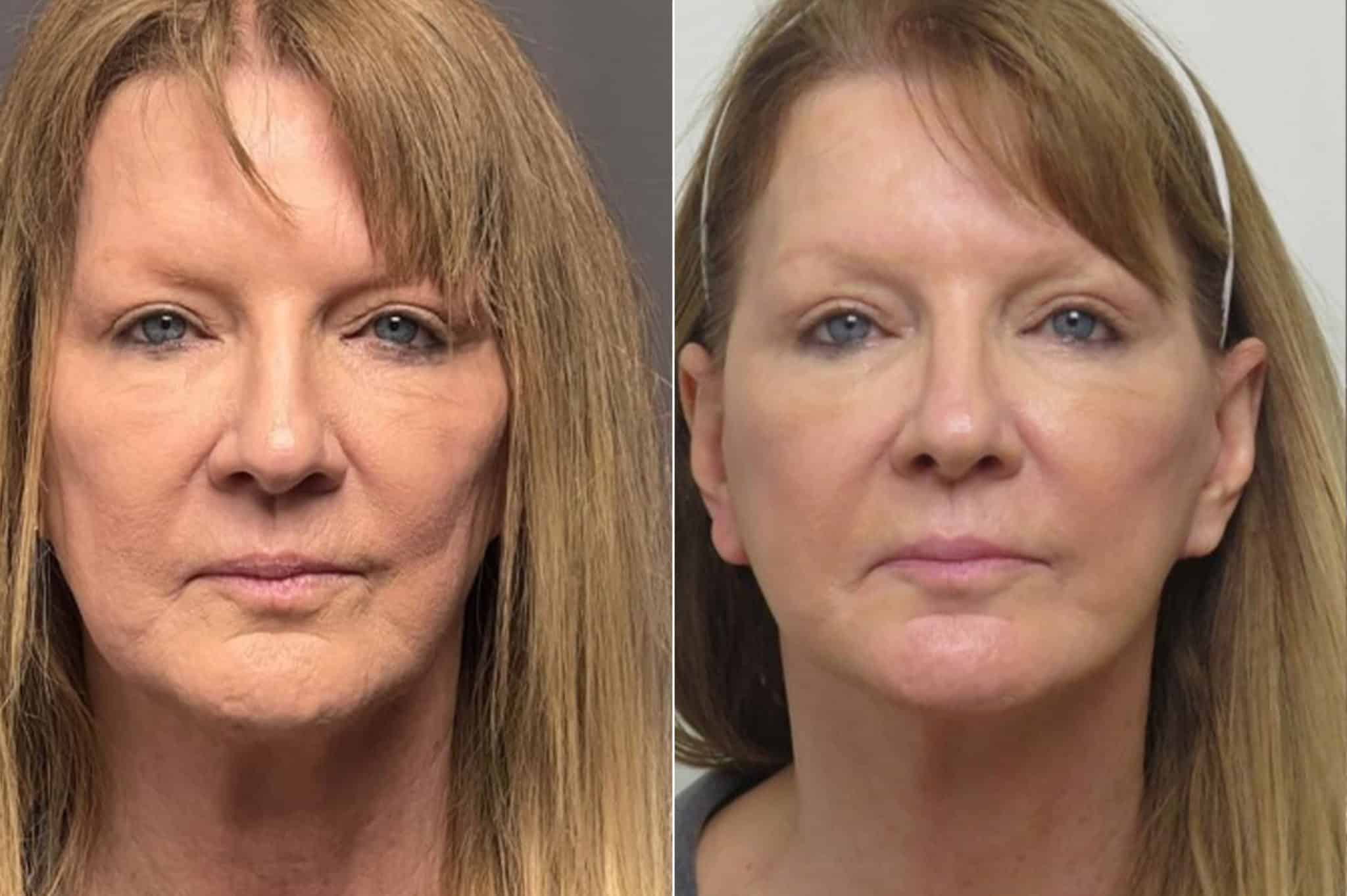 patient-1256-facelift-before-after-2048x1363