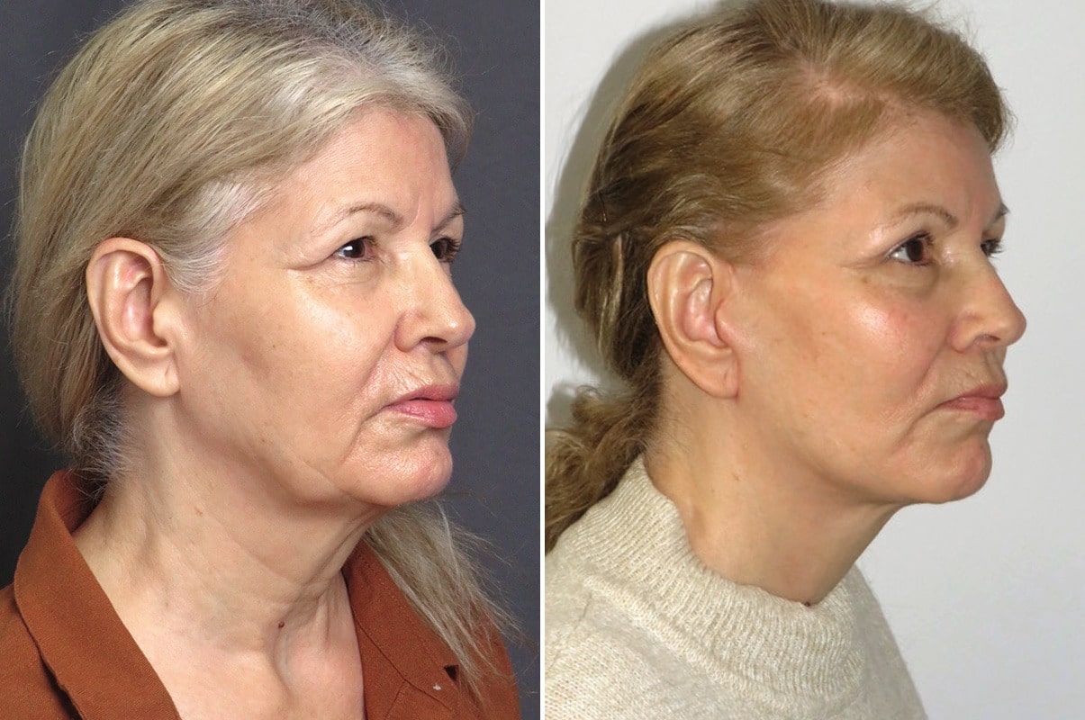 patient-1532-upper-eyelid-surgery-before-after-1