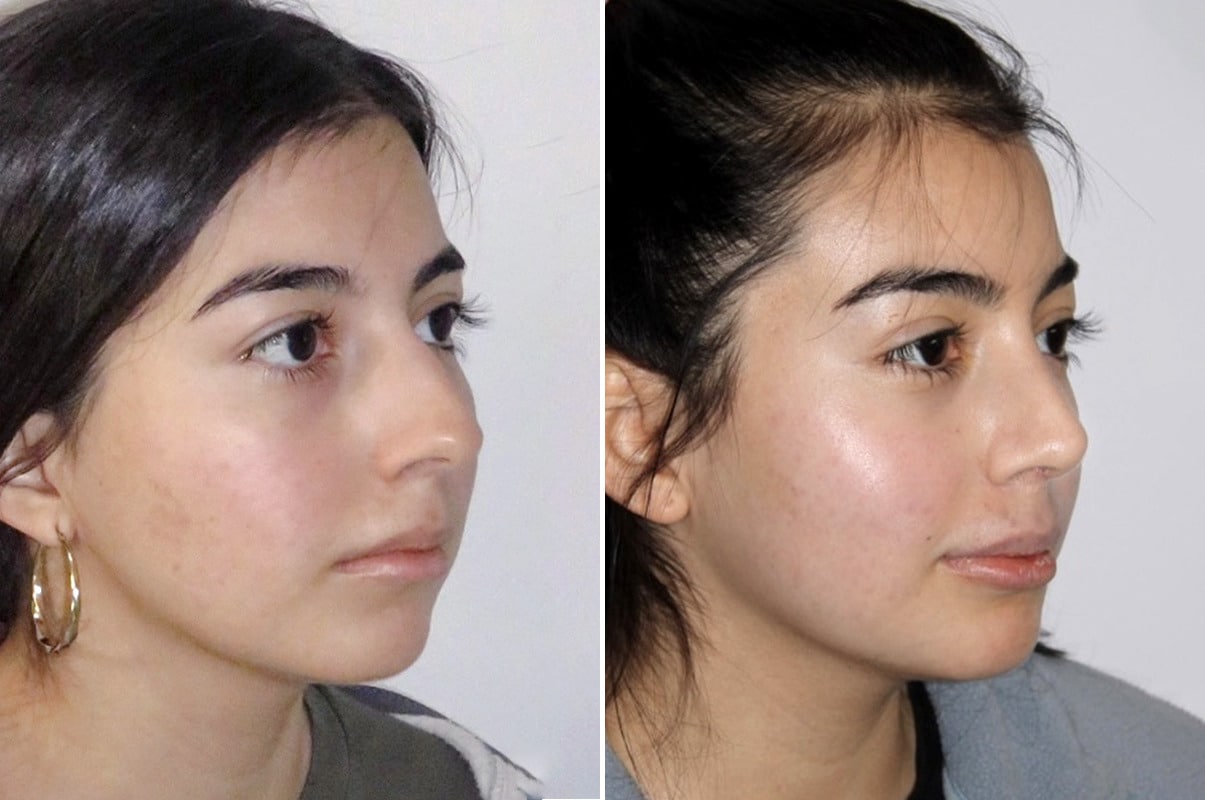patient-1627-rhinoplasty-before-after-10