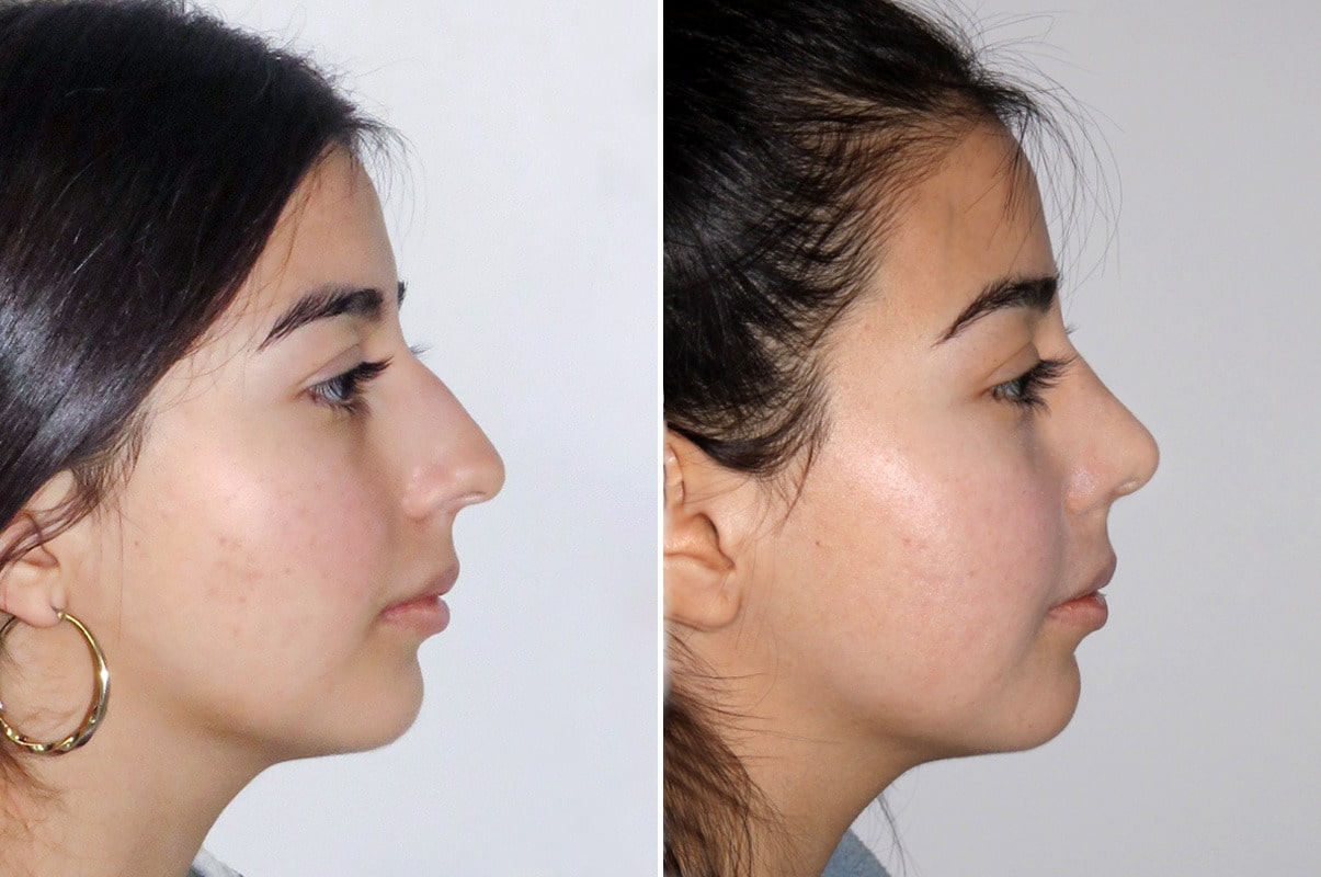 patient-1627-rhinoplasty-before-after-9