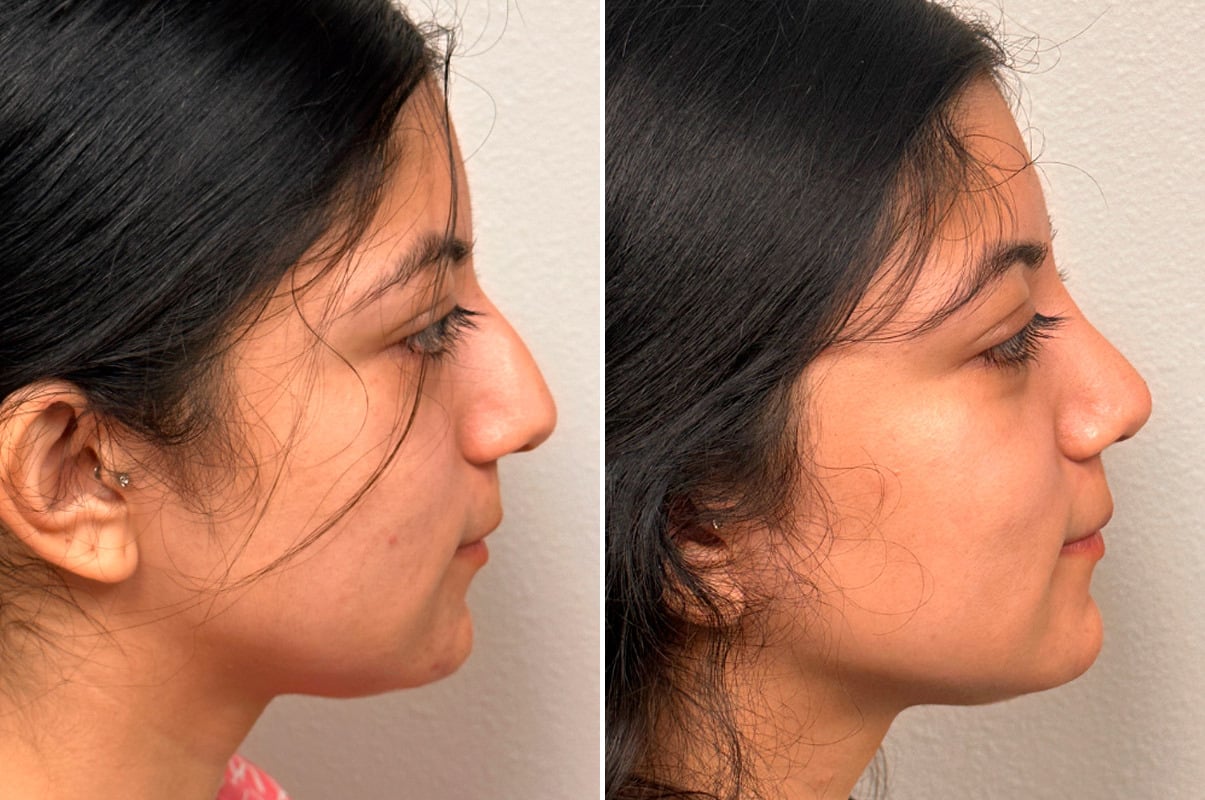 patient-1923-rhinoplasty-before-after-1