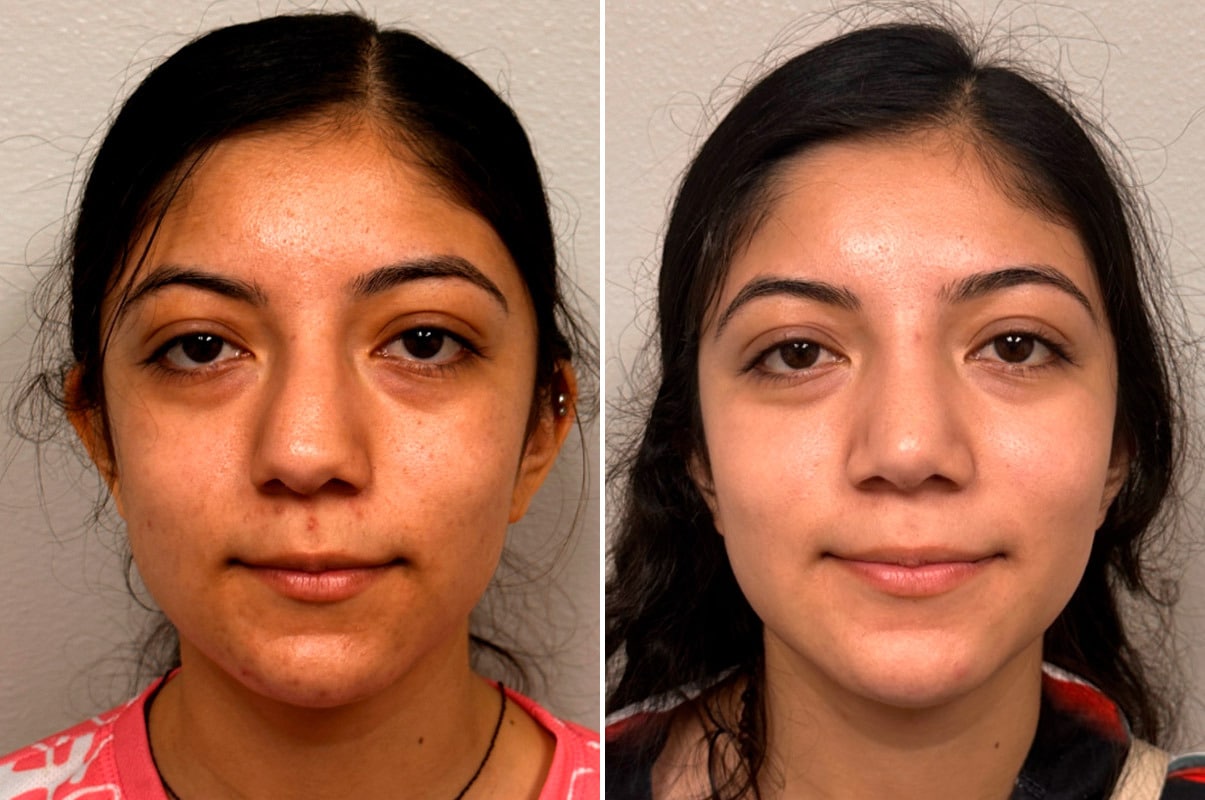 patient-1923-rhinoplasty-before-after