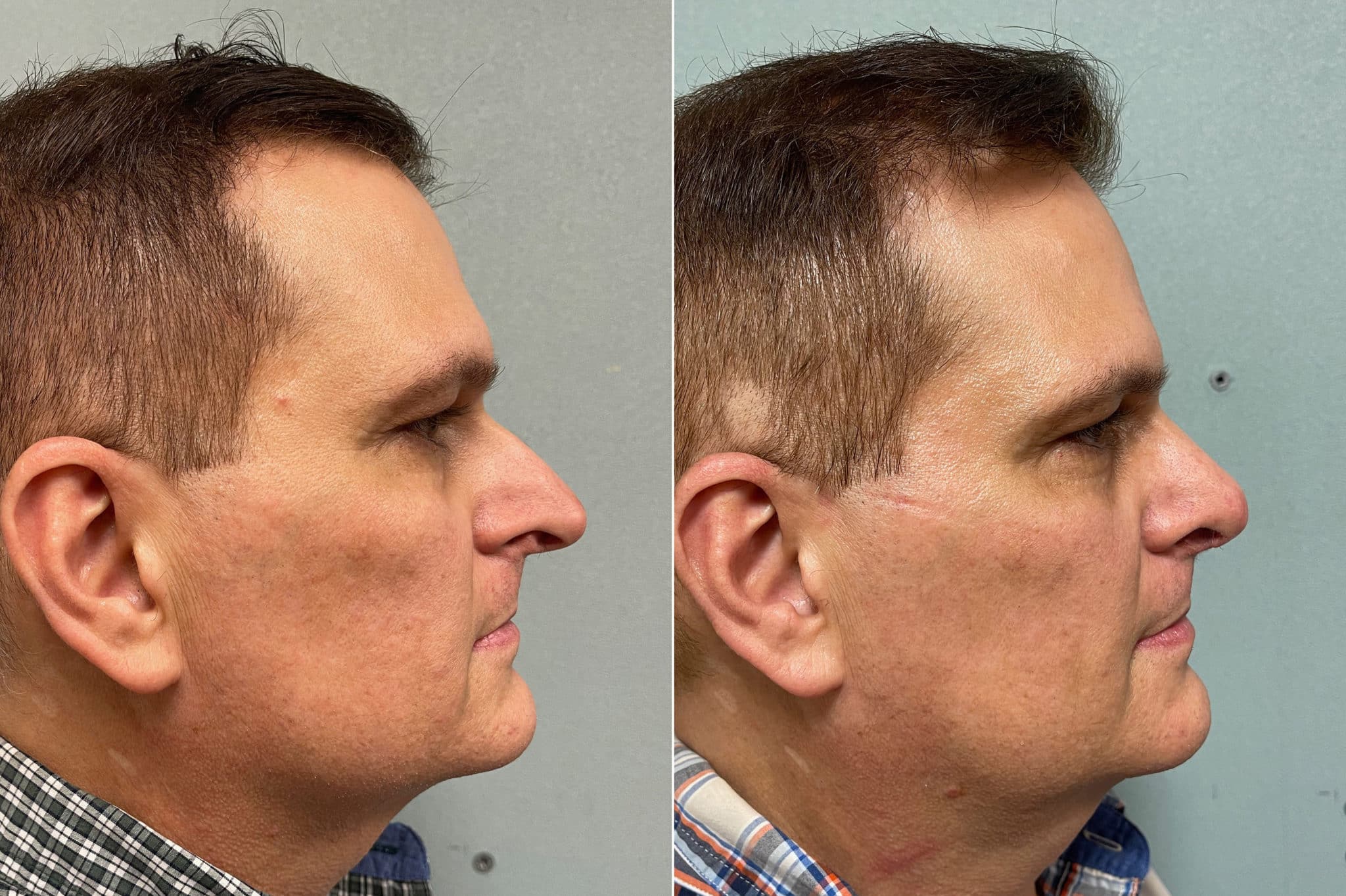 patient-200-rhinoplasty-before-after-1-2048x1363