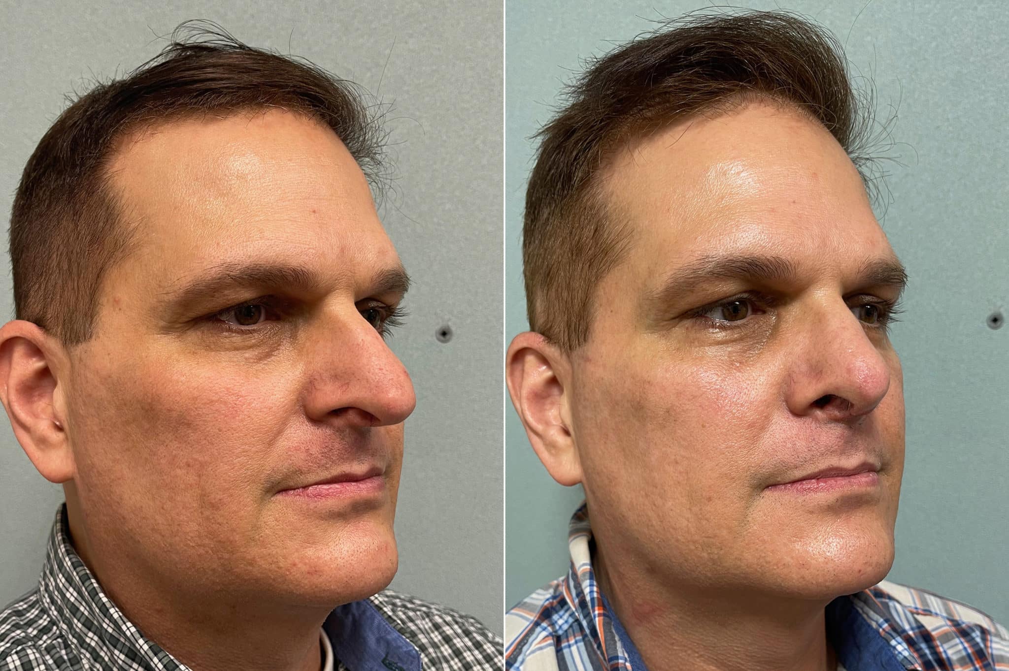 patient-200-rhinoplasty-before-after-2048x1363