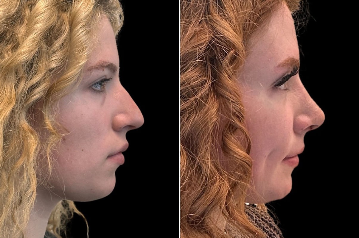 patient-2109-rhinoplasty-before-after-1