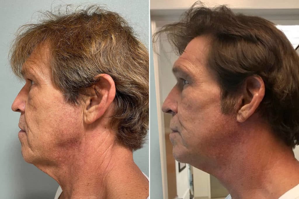 patient-266-facelift-before-after-1-1024x681