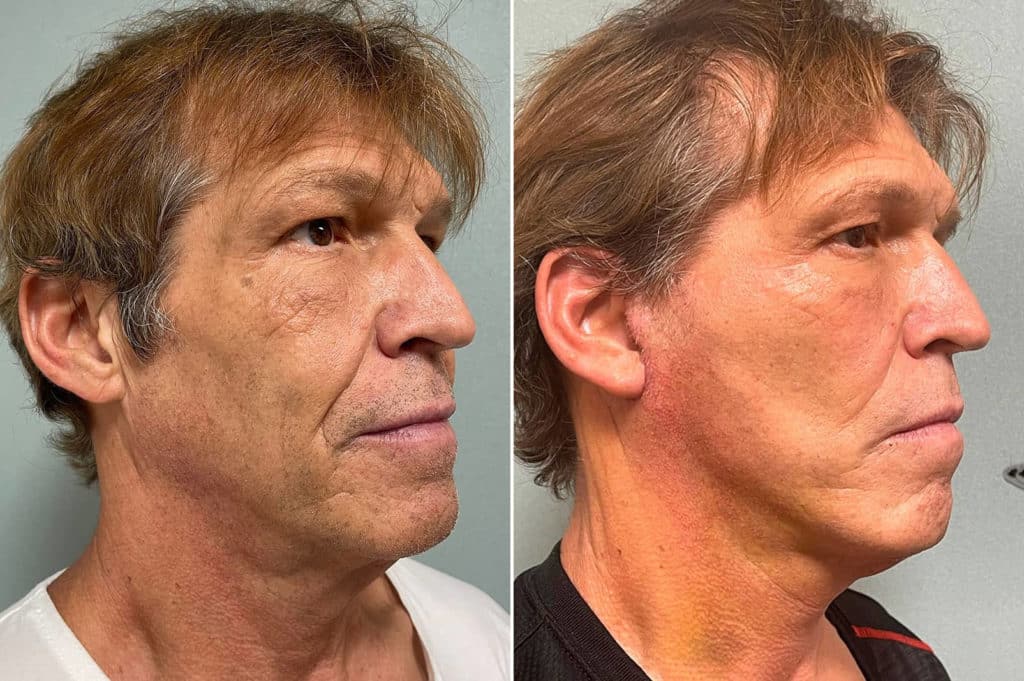 patient-266-facelift-before-after-1024x681