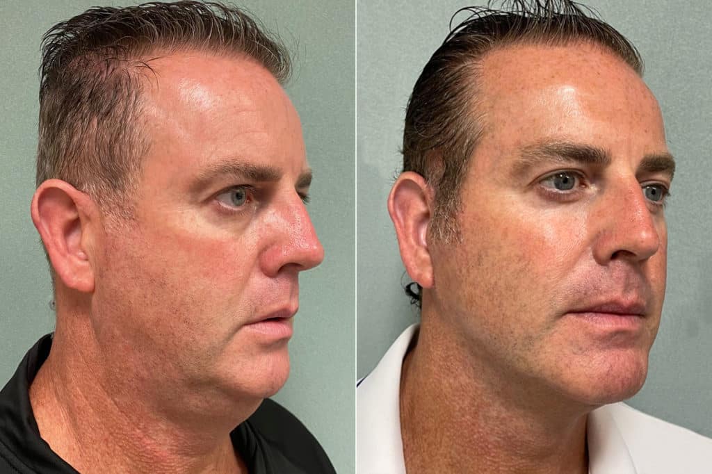 patient-268-facelift-before-after-2-1024x682