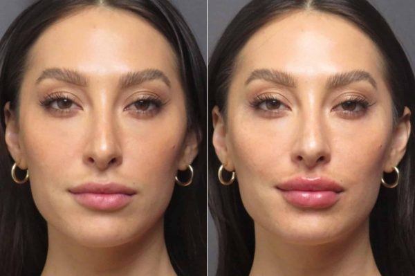 patient-1217-lip-filler-before-after-2048x1363