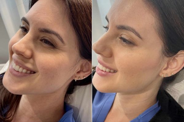 patient-648-botox-dysport-before-after-2048x1363